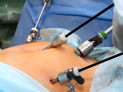 Hysterectomy